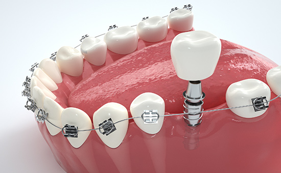 合肥种植牙的专业医院有几家_bb种植牙价格(图1) ycjz49.jpg